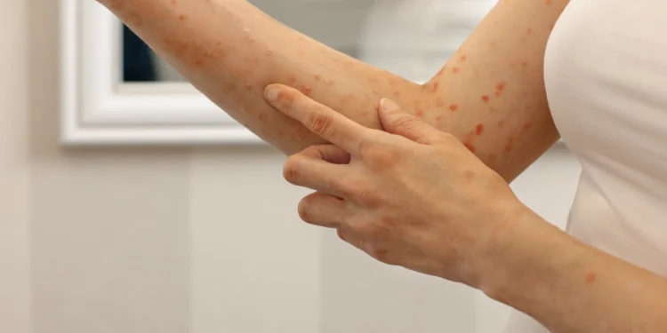 Oprez: Svrab se širi Hrvatskom – zaraženih ima i u našoj županiji